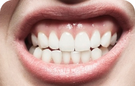 Desencaixe dos dentes ao morder