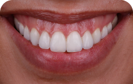 Exposição excessiva da gengiva ao sorrir (Sorriso gengival)