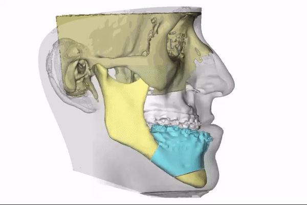 O que é Cirurgia Ortognática?